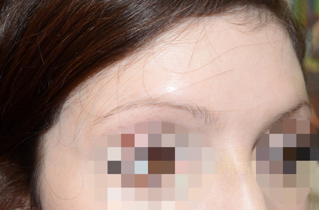 eyebrow transplant - patient 131 - before 3