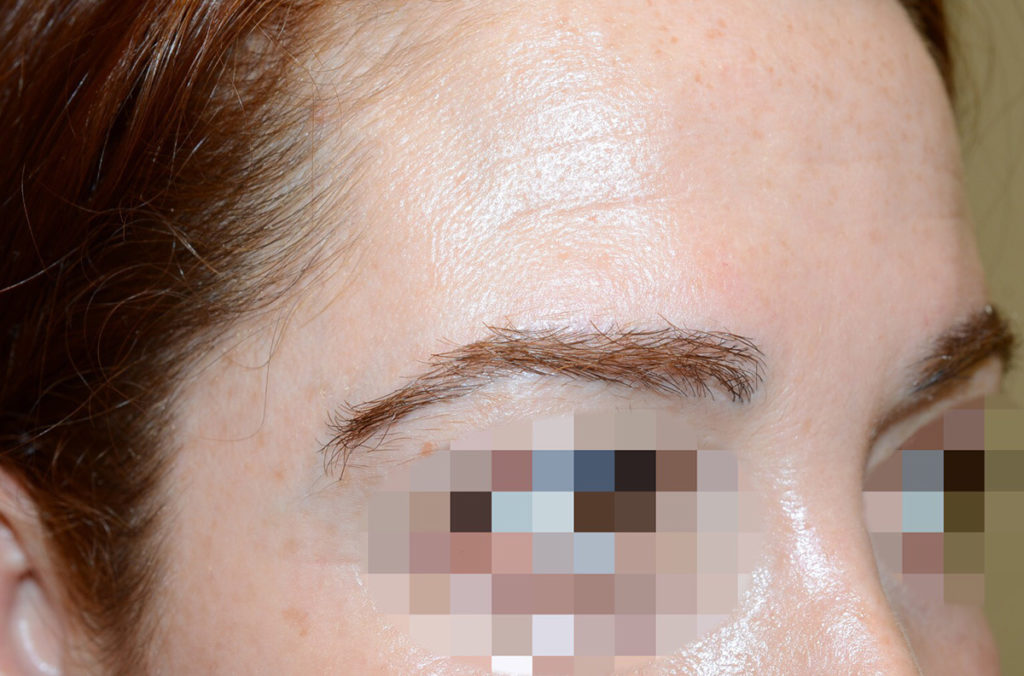 eyebrow transplant - patient 133 - after 3