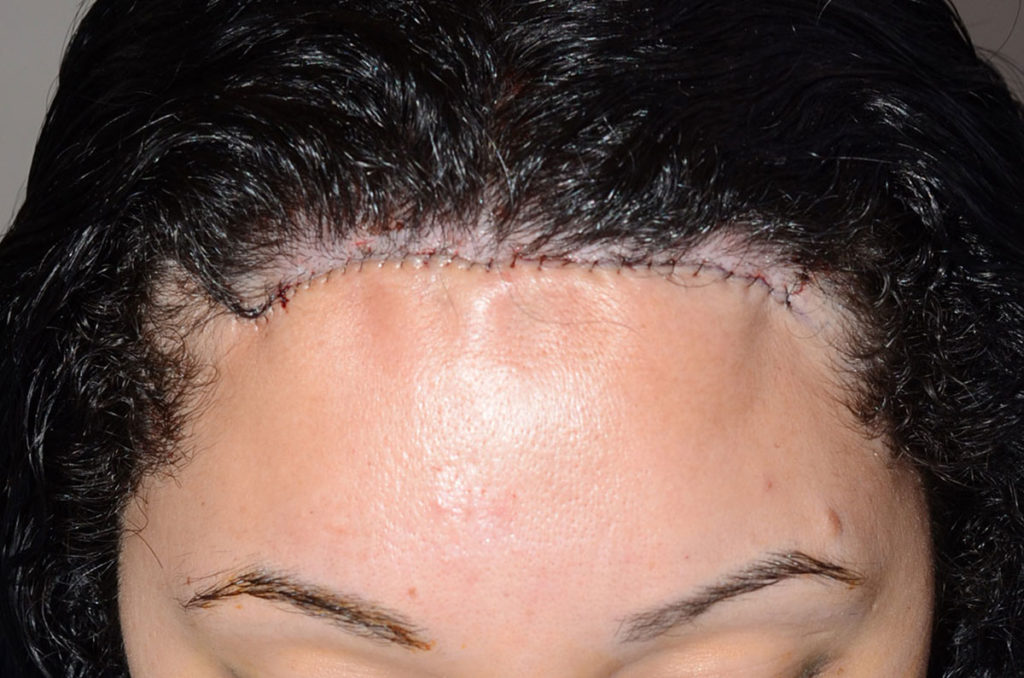 hairline advancement - patient 50 - after 1