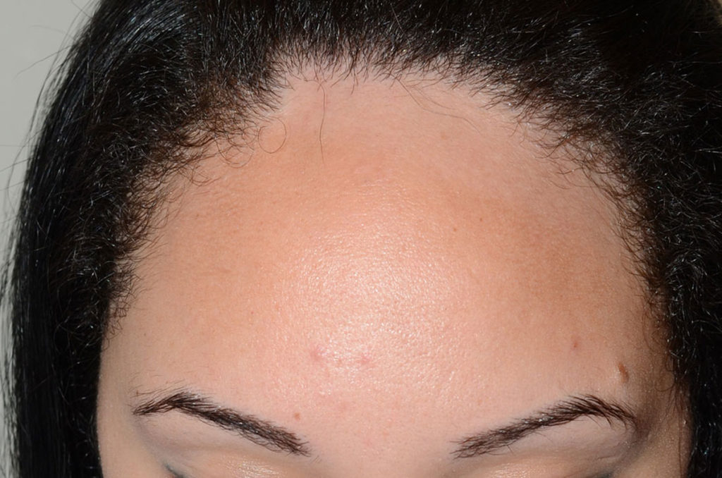 hairline advancement - patient 50 - before 1