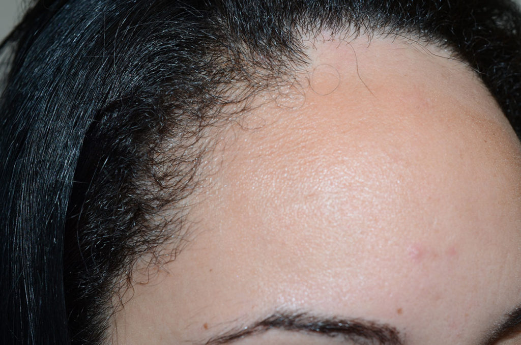 hairline advancement - patient 50 - before 3