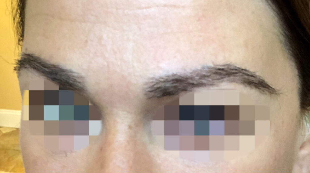 eyebrow transplant - patient 131 - after 1