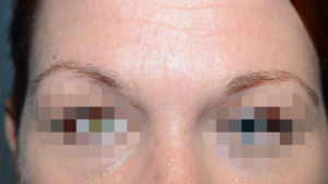 Miami, Fl Eyebrow transplant Photo - Patient 1 - Before 1