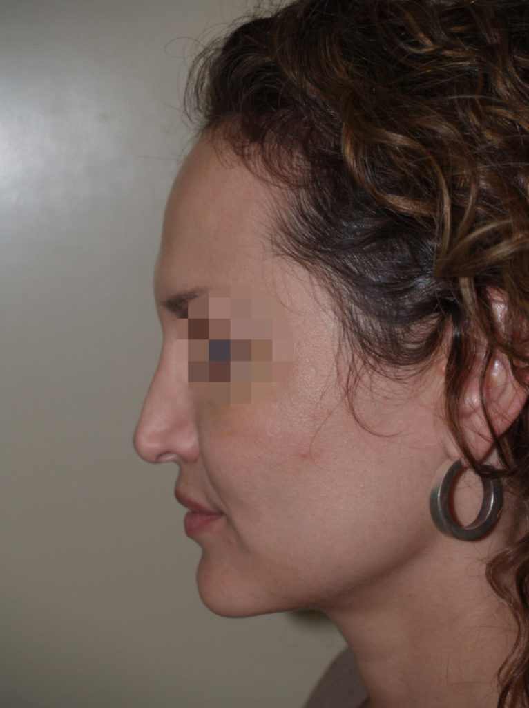 hairline advancement - patient 53 - before 3