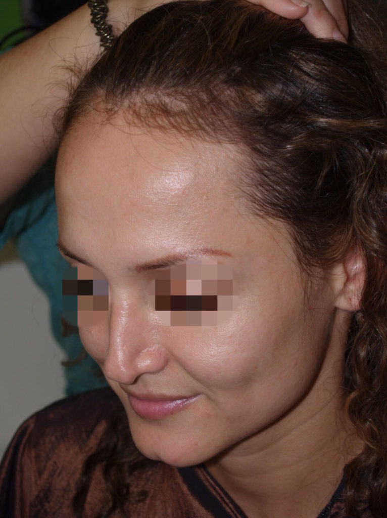 hairline advancement - patient 53 - before 2