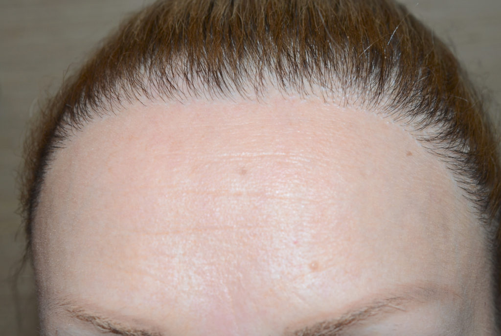 hairline advancement - patient 51 - after 1