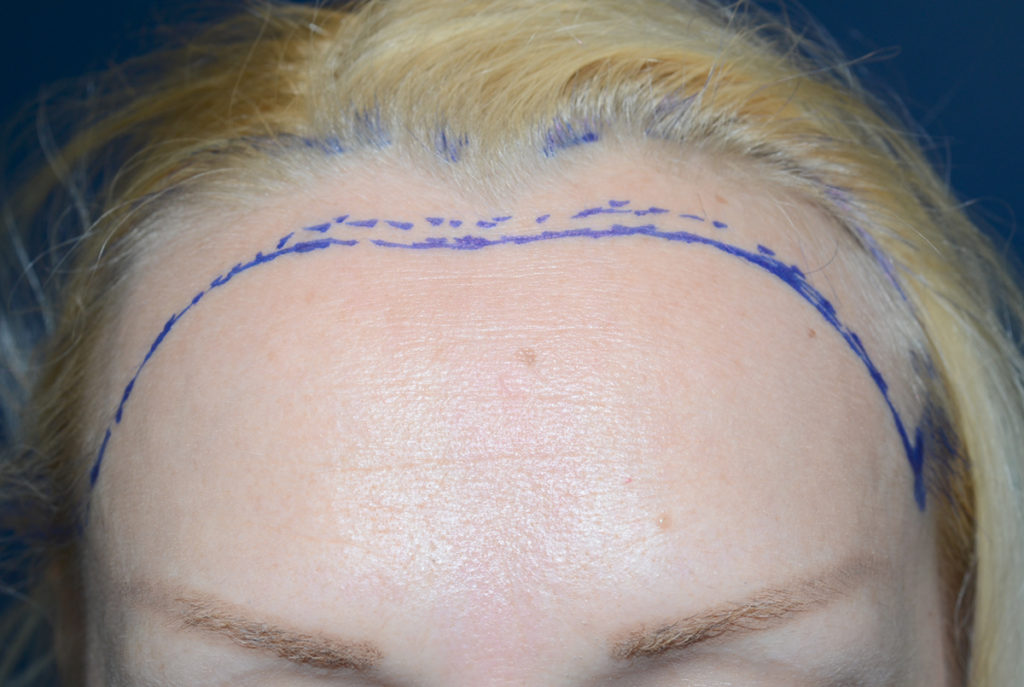 hairline advancement - patient 51 - before 1