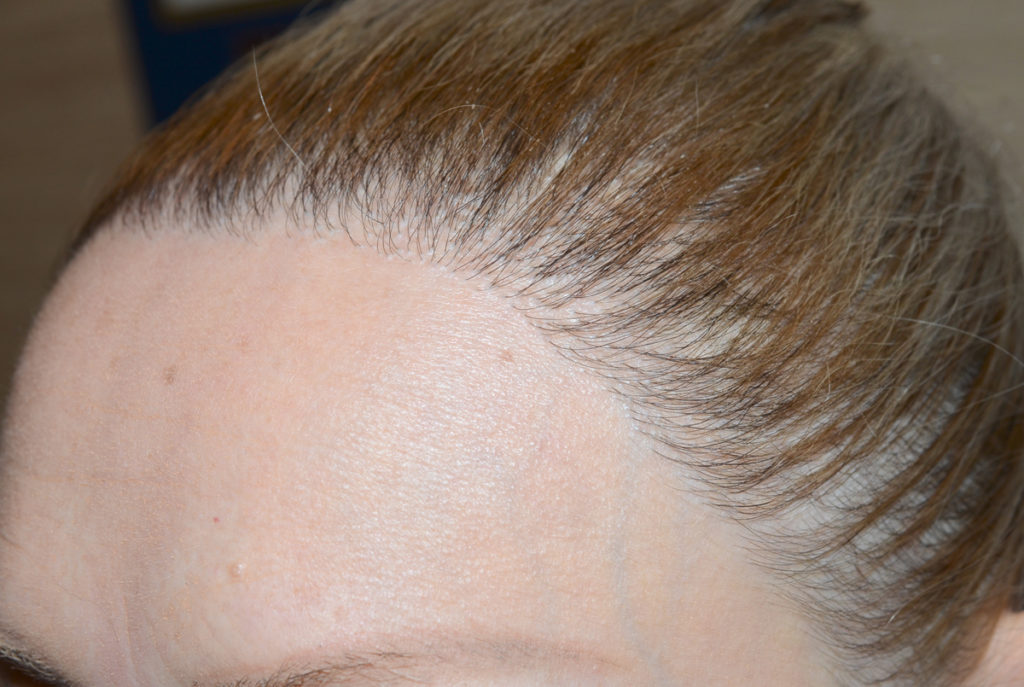 hairline advancement - patient 51 - after 3