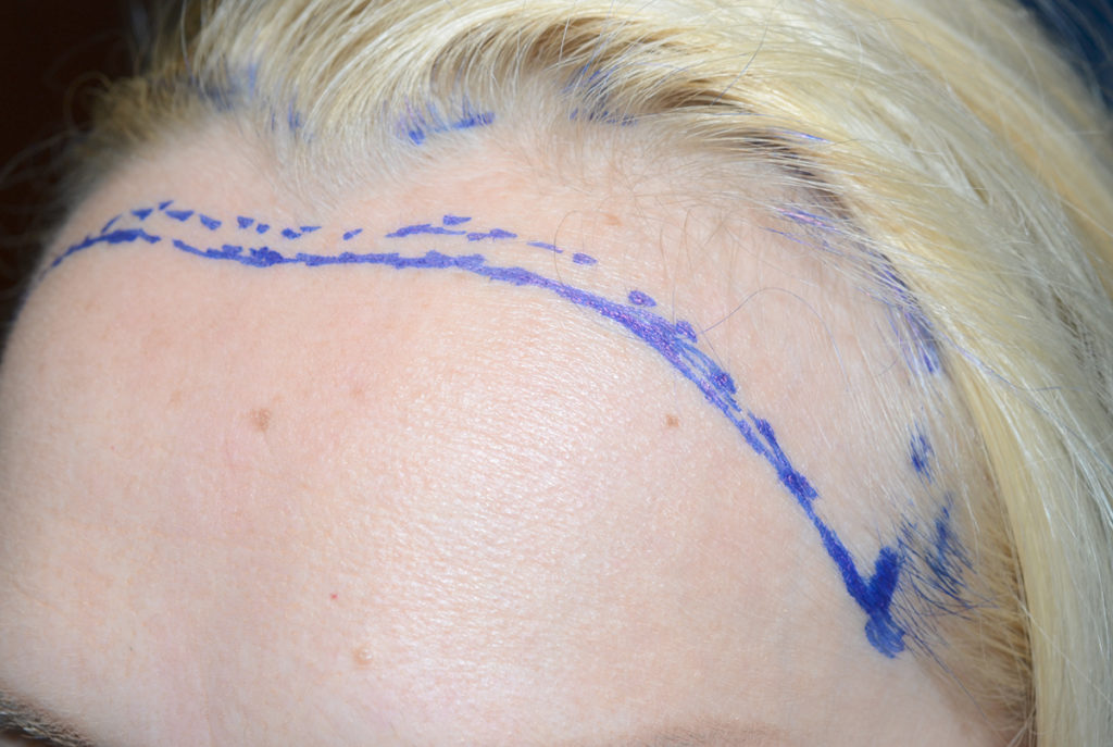 hairline advancement - patient 51 - before 3