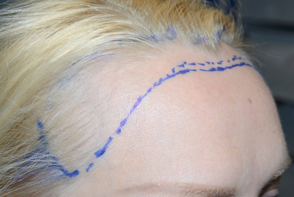hairline advancement - patient 51 - before 2