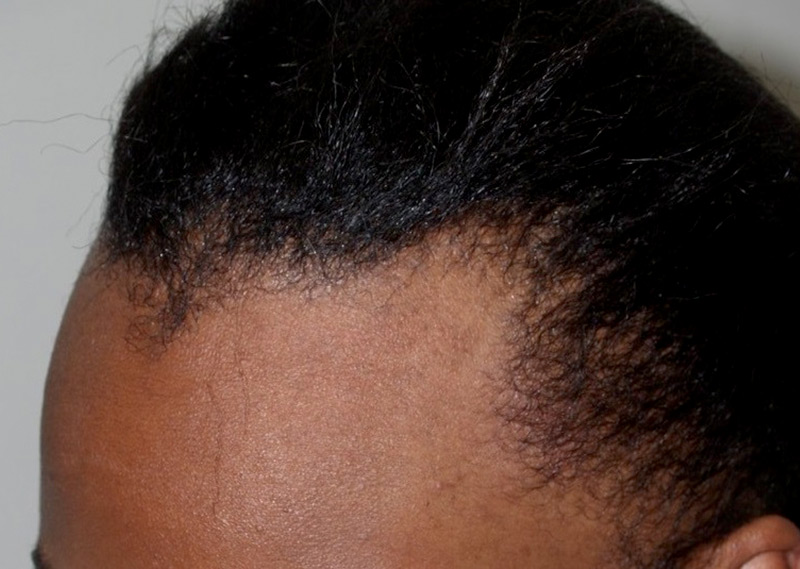 hairline advancement - patient 52 - before 2