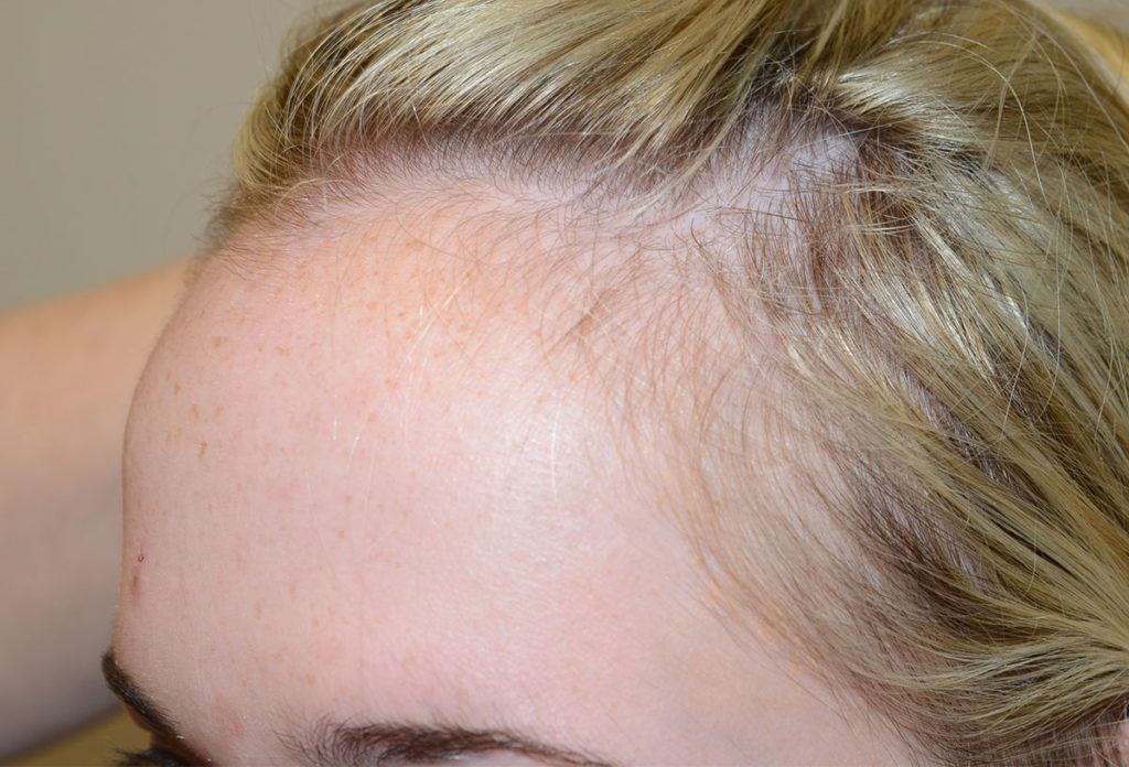 hairline advancement - patient 54 - before 3