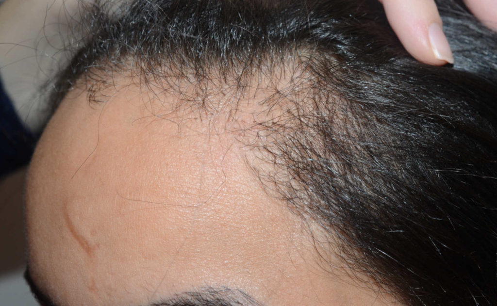 hairline advancement - patient 55 - before 2