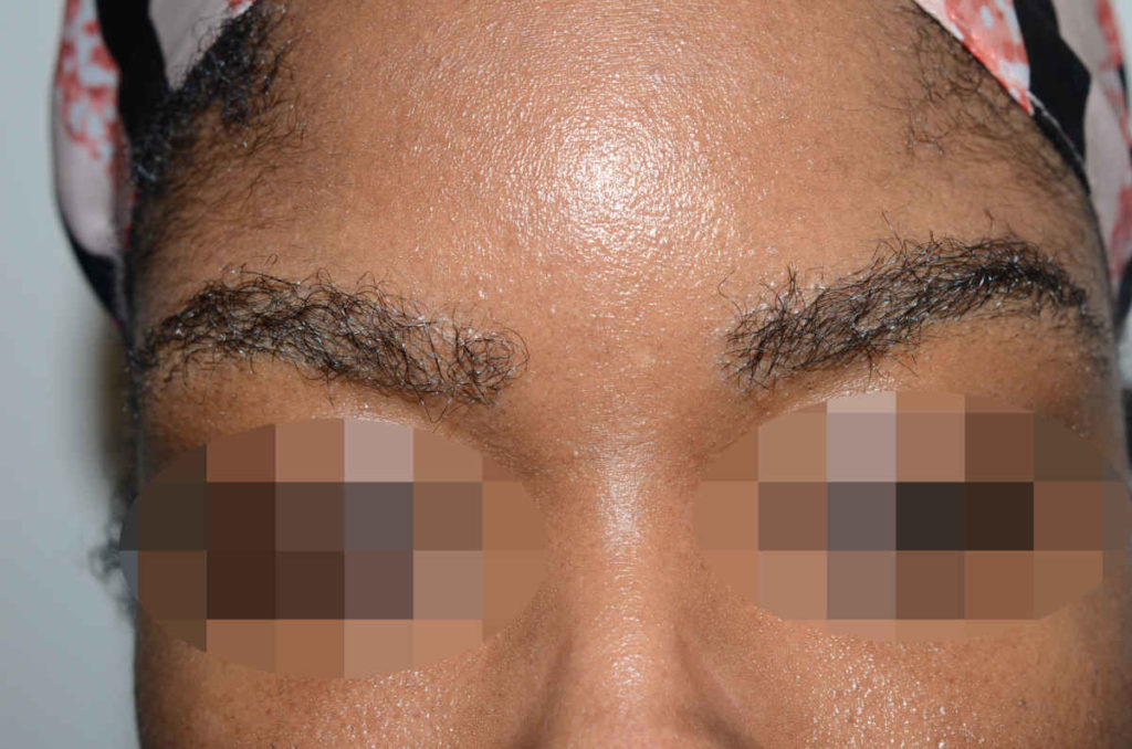 eyebrows and eyelashes - patient 10370 - after immediately 1
