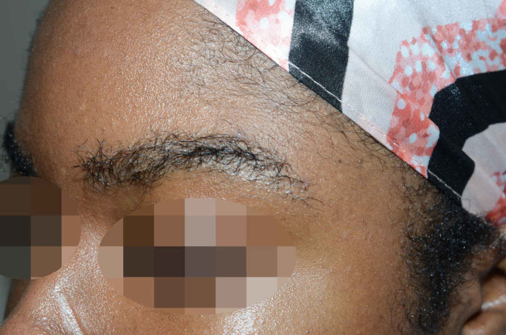 eyebrows and eyelashes - patient 10370 - after immediately 2