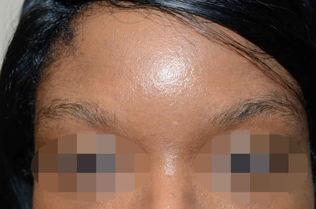eyebrows and eyelashes - patient 10370 - before 1