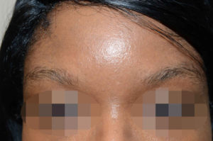 Miami, Fl. Eyebrows and Eyelashes Photo - Patient 1 - Before 1