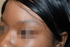 Miami, Fl. Eyebrows and Eyelashes Photo - Patient 1 - Before 2