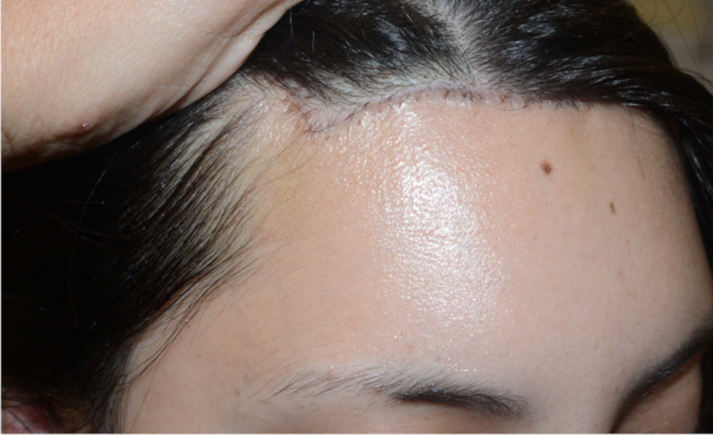 hairline advancement - patient 55 - after 2