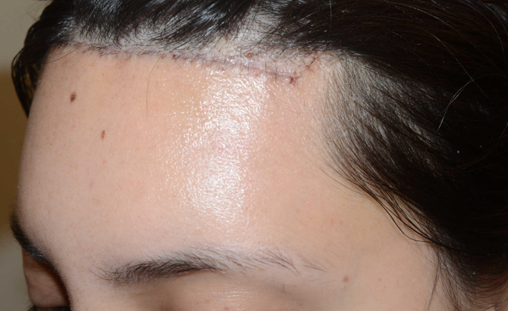 hairline advancement - patient 55 - after 3