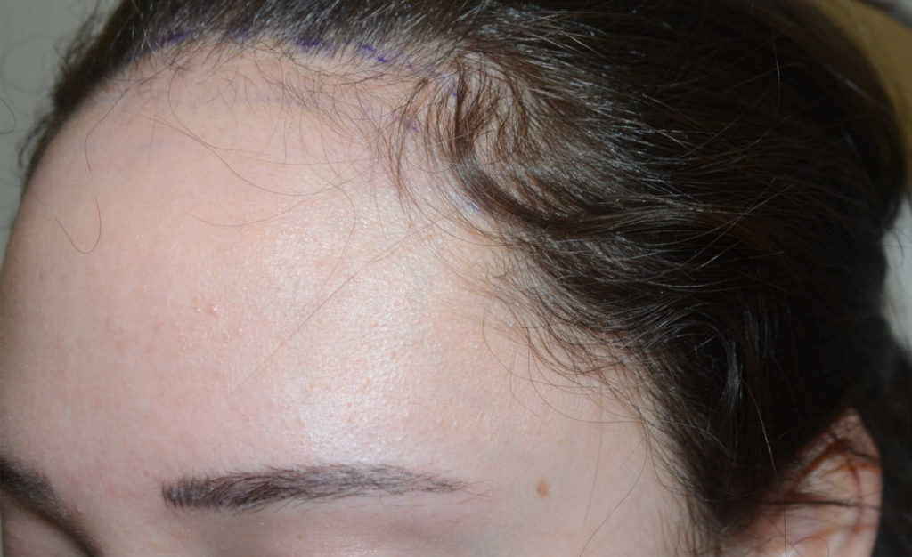 hairline advancement - patient 55 - before 3