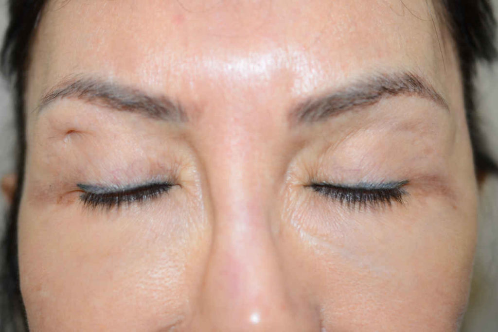 eyebrows transplant - patient 10380 - before 3