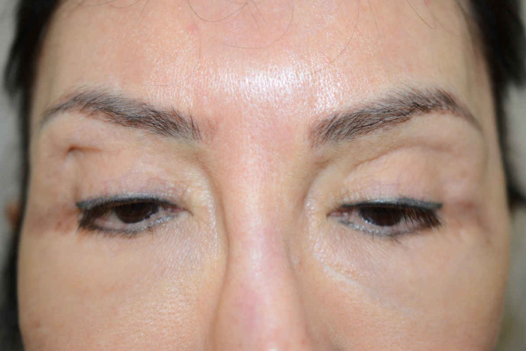eyebrows transplant - patient 10380 - before 1