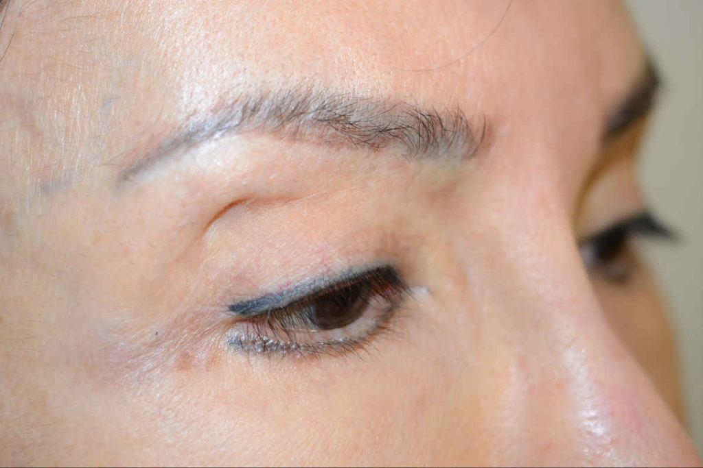 eyebrows transplant - patient 10380 - before 2