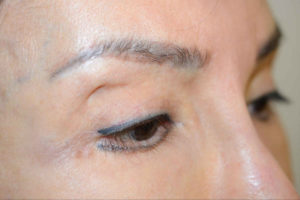 Miami, Fl. Eyebrows transplant Photo - Patient 1 - Before 2