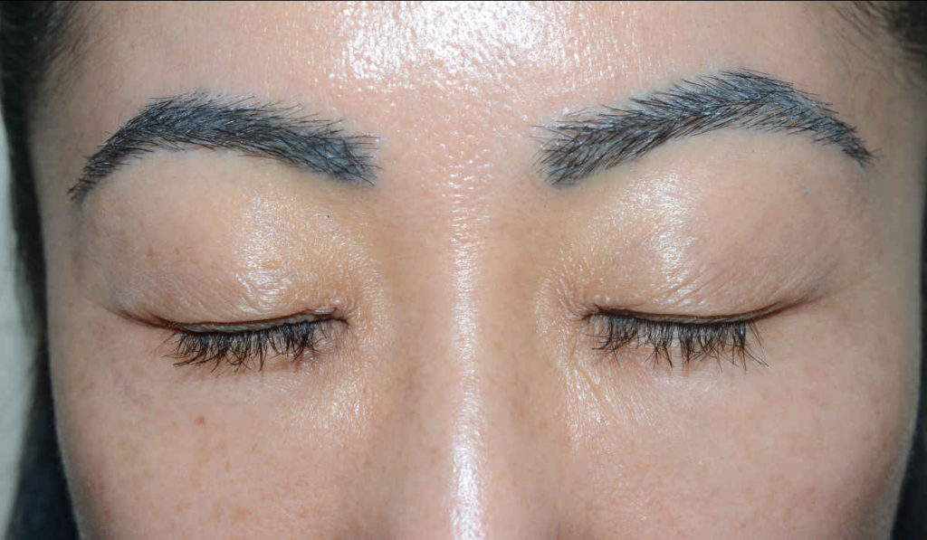eyebrows transplant - patient 10418 - after 1