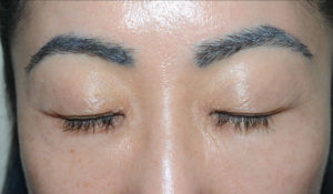 Miami, Fl. Eyebrows transplant Photo - Patient 1 - After 1