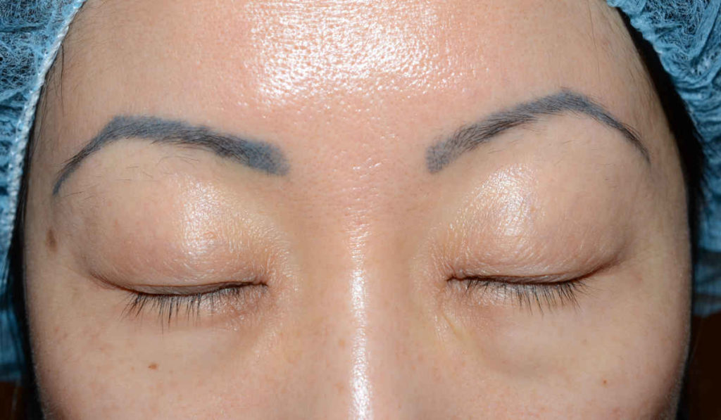 eyebrows transplant - patient 10418 - before 1