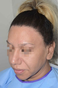 Miami, Fl. Special Cases Photo - Patient 1 - After 2