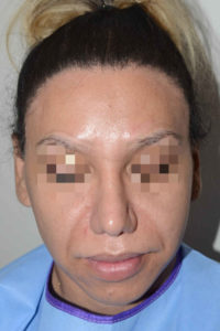Miami, Fl. Special Cases Photo - Patient 1 - After 1