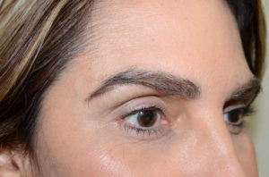 Miami, Fl. Eyebrows transplant Photo - Patient 1 - After 2