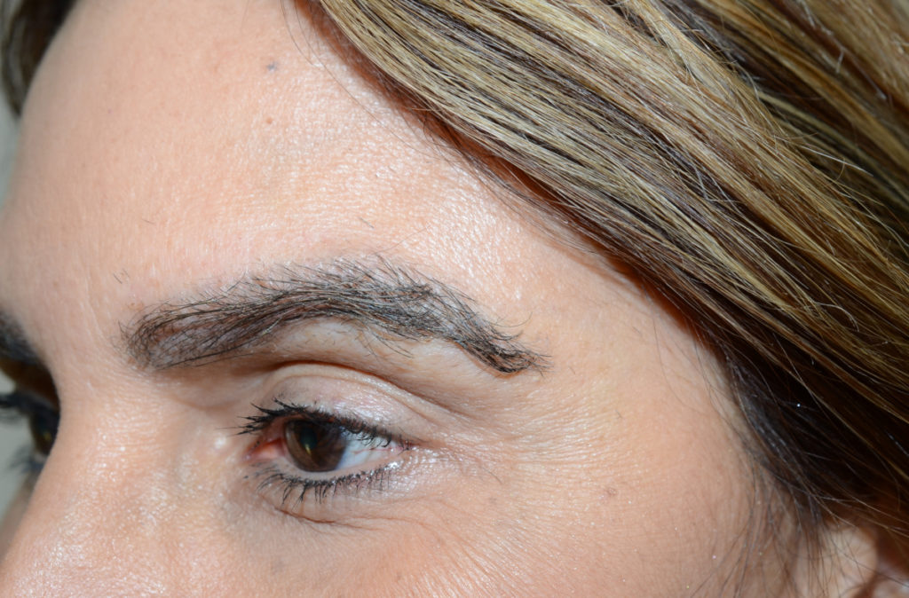 eyebrows transplant - patient Patien 10413 - after 1