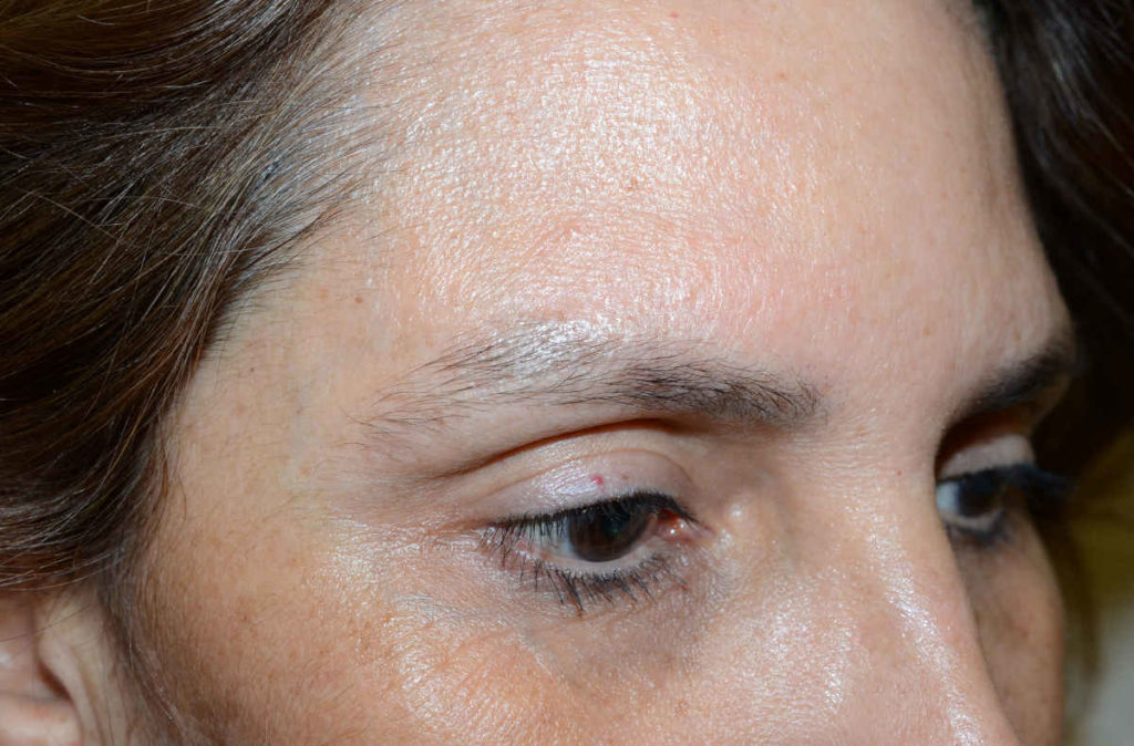 eyebrows transplant - patient Patien 10413 - before 2