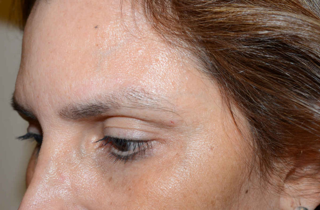 eyebrows transplant - patient Patien 10413 - before 1