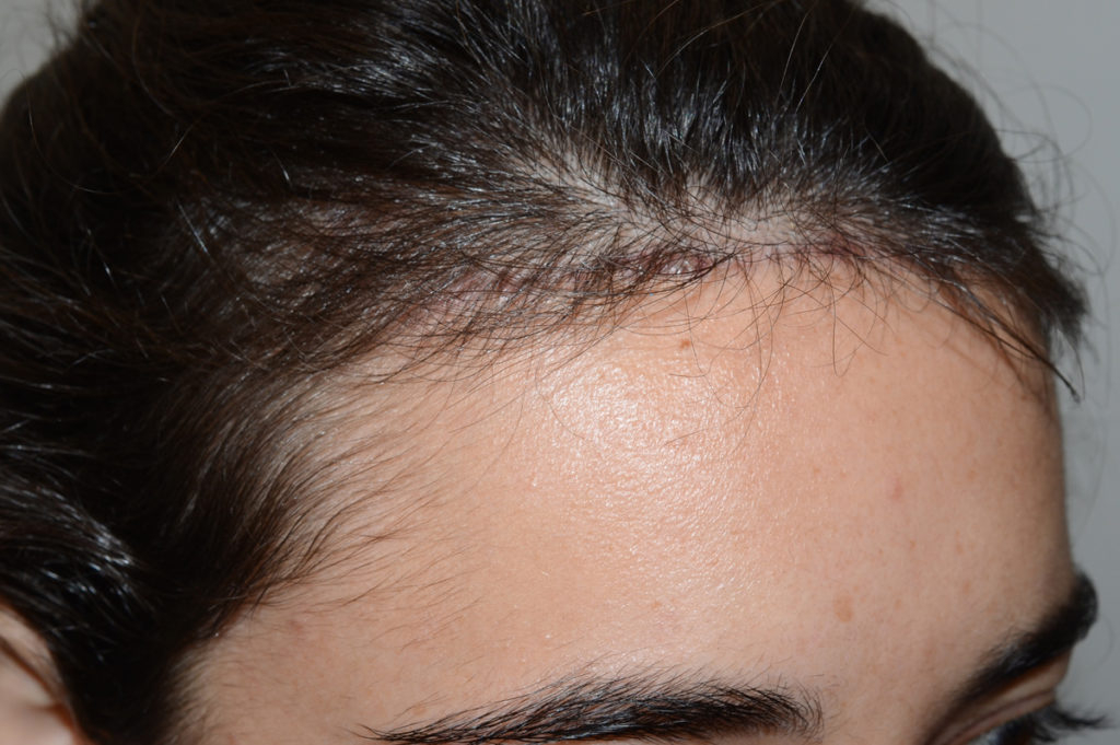 hairline advancement - patient Patient - after 1