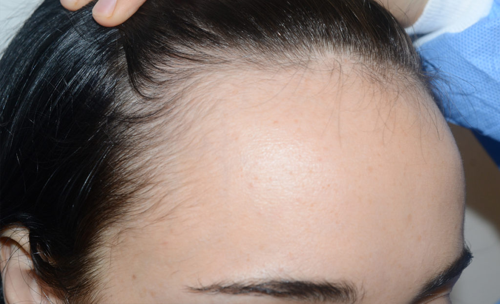 hairline advancement - patient Patient - before 3