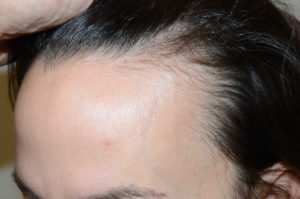  Hairline Advancement Photo - Patient 1 - Before 1