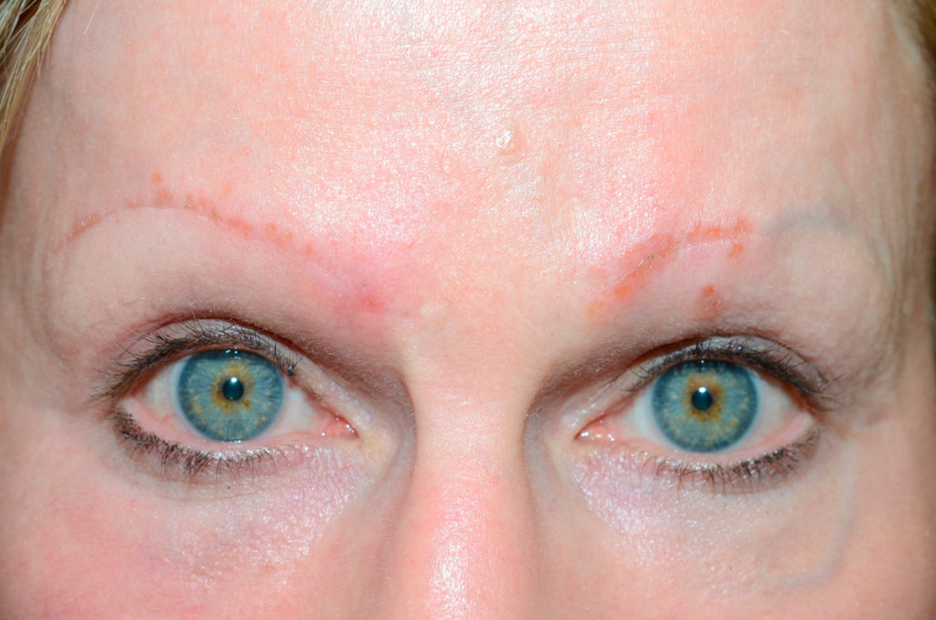 eyebrows transplant - patient  - before 1