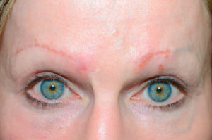 Miami, Fl. Eyebrows transplant Photo - Patient 1 - Before 1