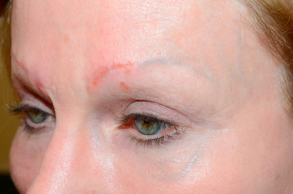 eyebrows transplant - patient  - before 3