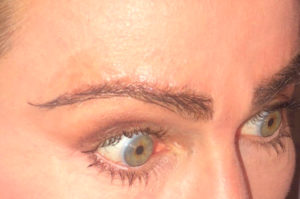 Miami, Fl. Eyebrows transplant Photo - Patient 1 - After 2