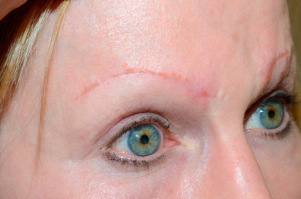eyebrows transplant - patient  - before 2