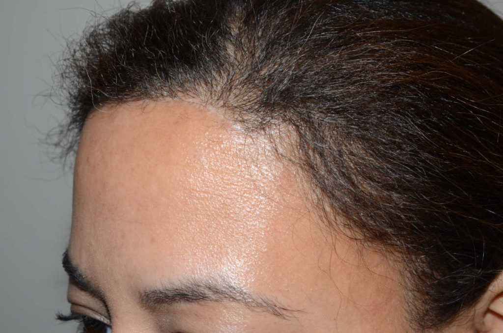 hairline advancement - patient 10469 - after 2