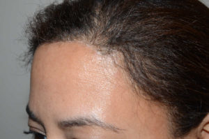  Hairline Advancement Photo - Patient 1 - After 2