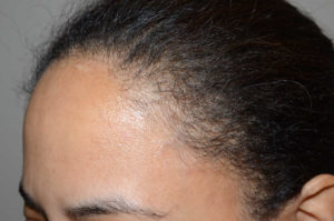  Hairline Advancement Photo - Patient 1 - Before 2
