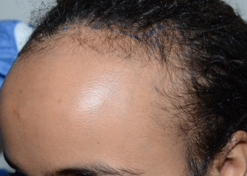 hairline advancement - patient 61 - before 2